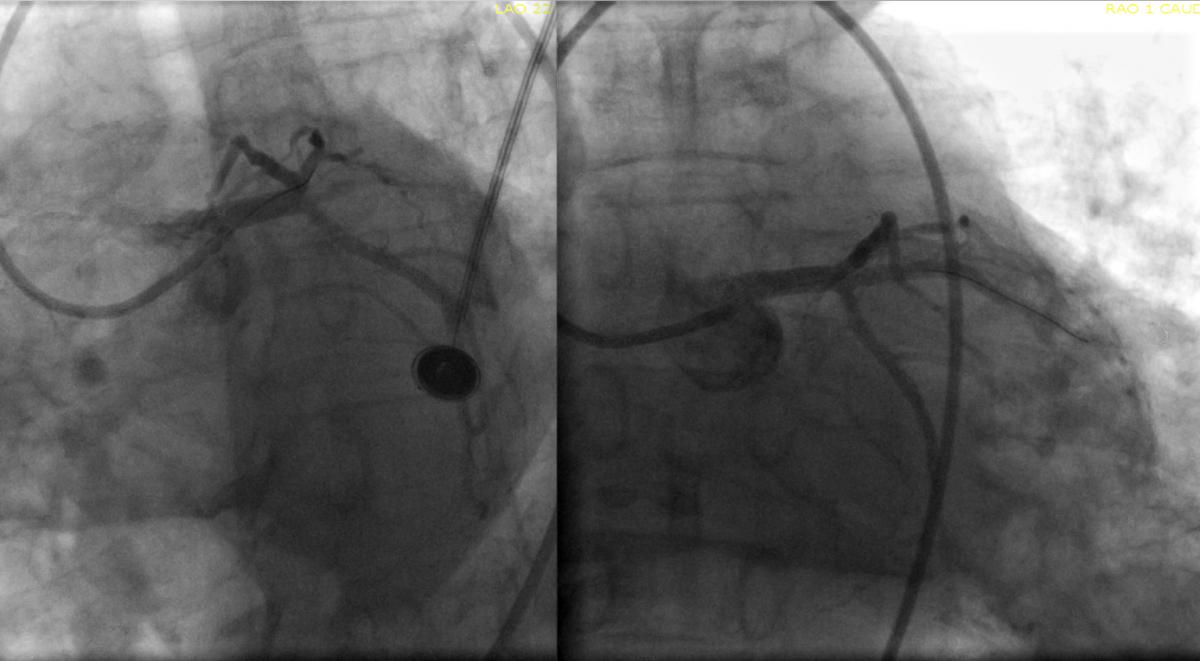 Comparison of a STEMI coronary artery blockage pre and post PCI.
