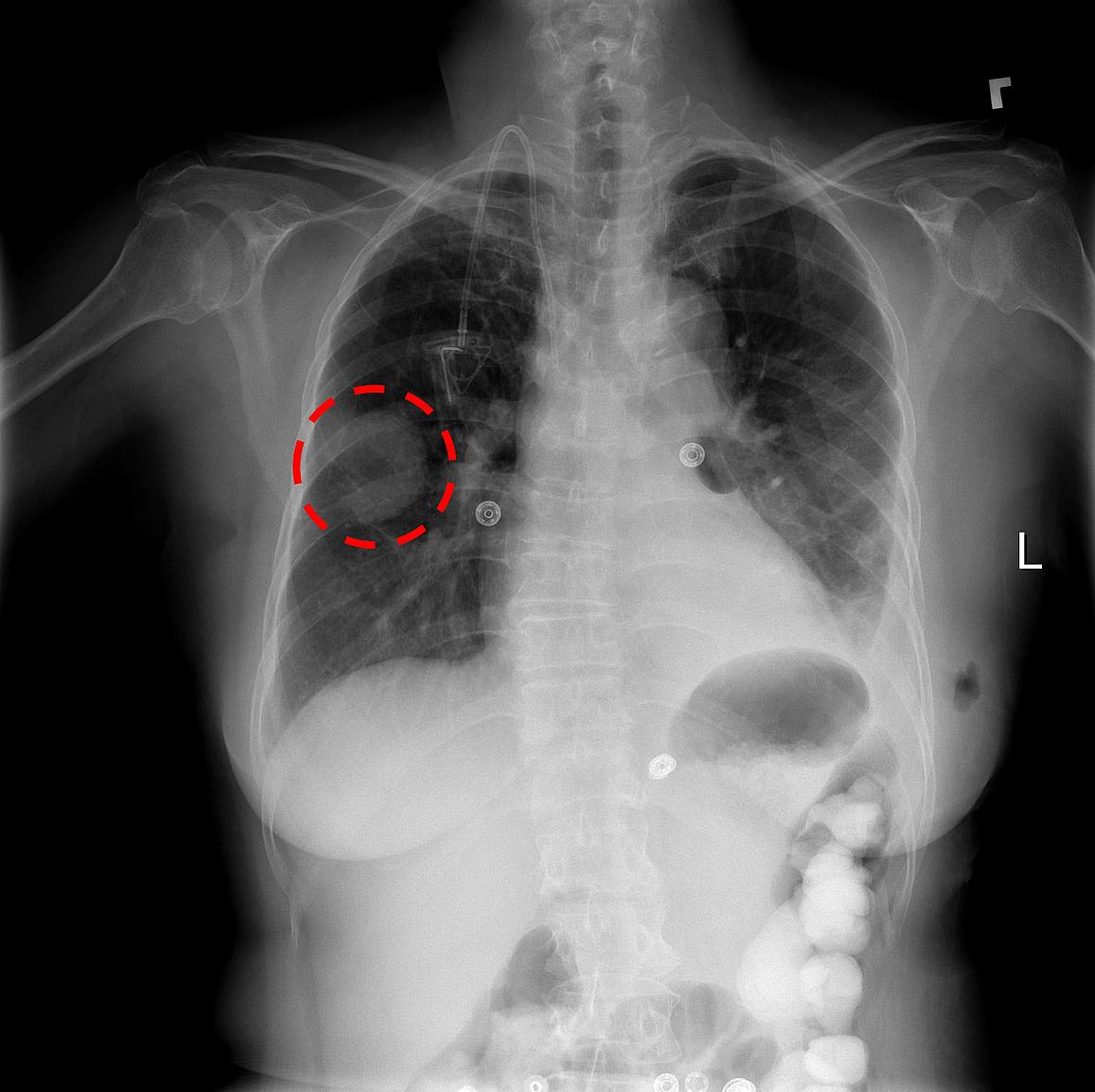 Chest X Ray Cheat Dumper